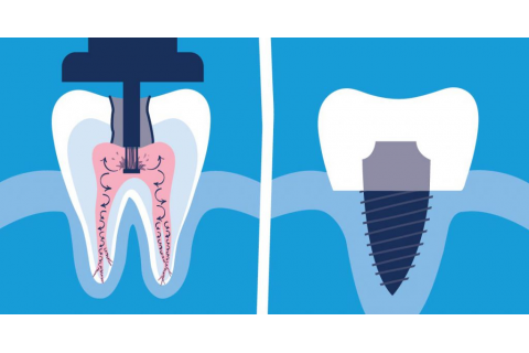 انتخاب درمان ریشه یا ایمپلنت دندان