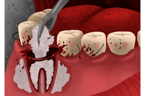 روش های آبچوره دندان و نسل های سیلر جدید