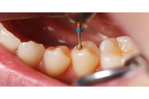 نگات کلیدی برای دستیابی به بهترین نتیجه در بلیچینگ دندان