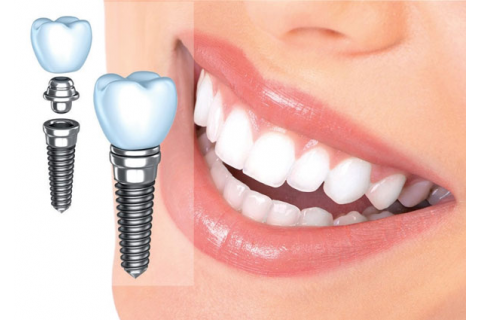 هزینه تقریبی ایمپلنت دندان براساس چه فاکتورهای تعیین می شود