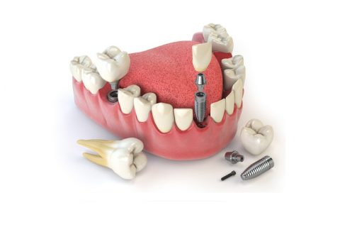 ماندگاری ایمپلنت دندان چه میزان است 