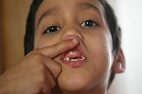 پیشگیری از آبسه دندان در کودکان