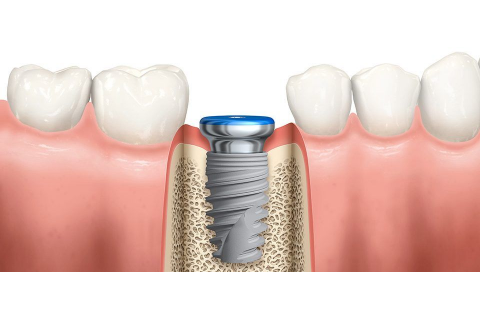 پیشگیری و کنترل سه عفونت رایج و نگران کننده در دندانپزشکی