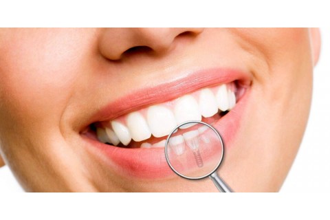هزینه ایمپلنت دندان به چه عواملی بستگی دارد