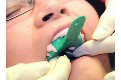 جایگزینی دندان از دست رفته با ایمپلنت یا بریج کدامیک ماندگارتر است 