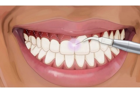 مقایسه لیزر و الکترو سرجری و کاربرد های آنها در حوزه دندانپزشکی