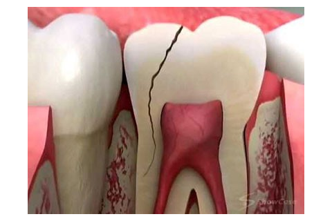 راههای جلوگیری و درمان ترک دندان 